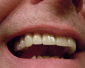 Fissurenversiegelung