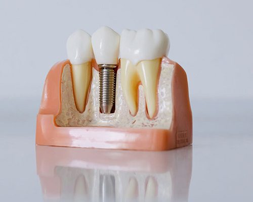 Zahnimplantate